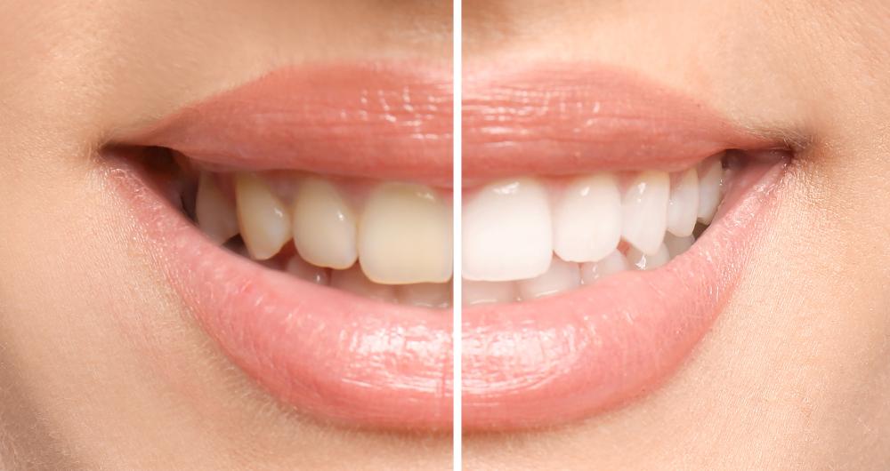 before and after teeth whitening photo | cosmetic dentist bedford