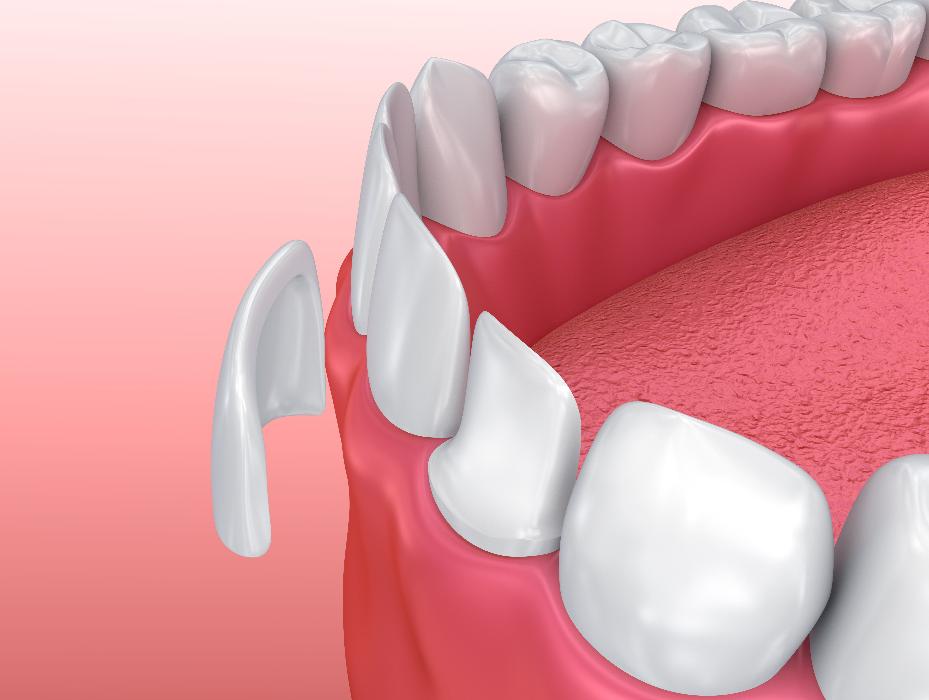 close up of veneers | dentist goffstown nh