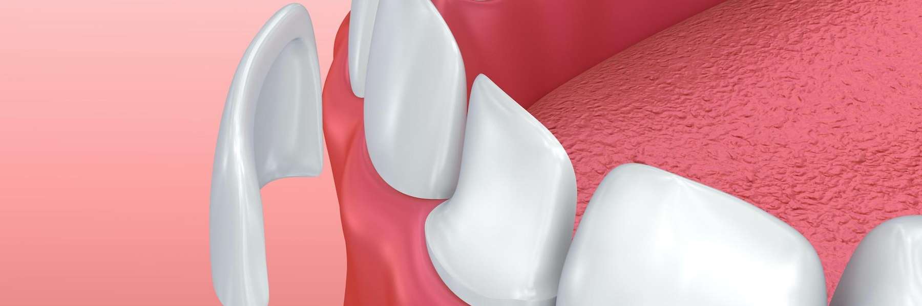 dental veneers in Goffstown NH