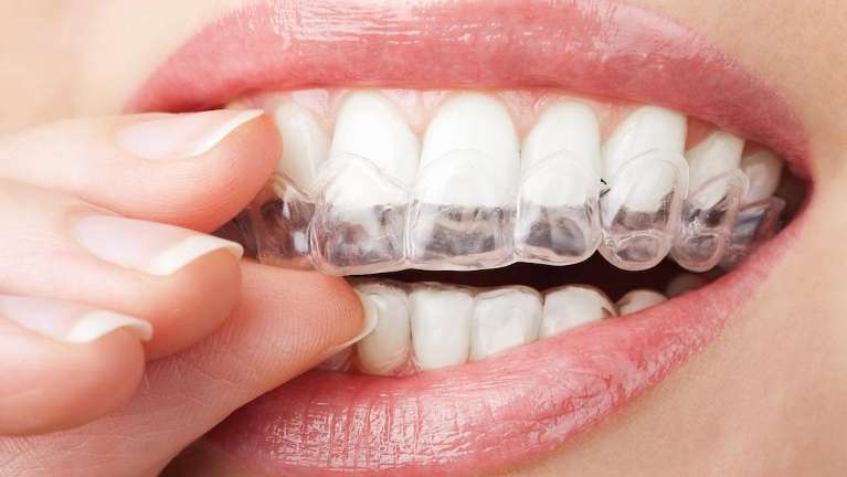 patient putting in clear plastic aligner | invisalign goffstown nh