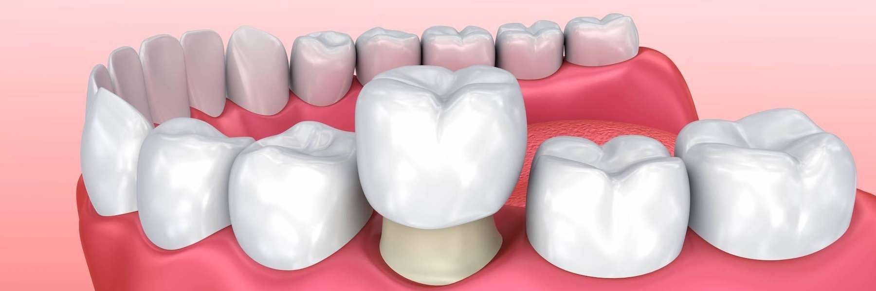 dental crowns benefits