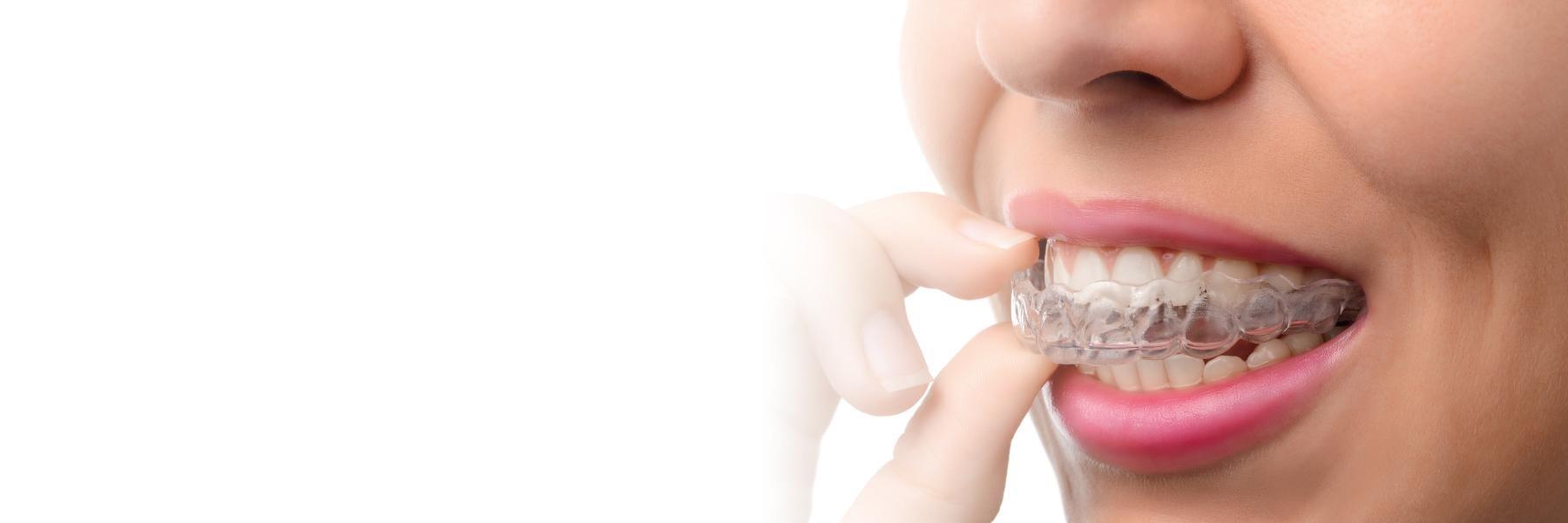 woman putting in clear plastic aligner l invisalign goffstown nh