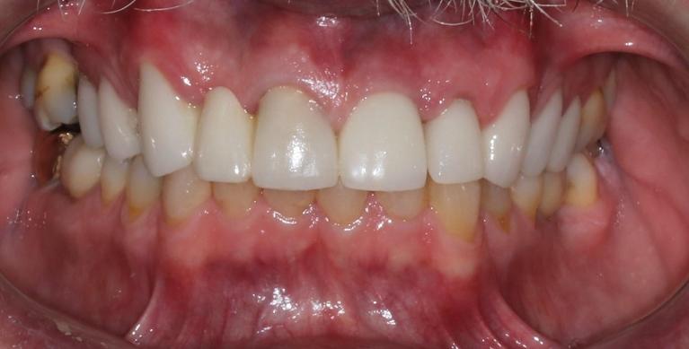 complete smile after dental implants l goffstown dental