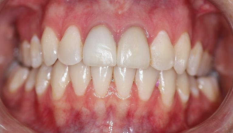 straightened smile after dental treatment l goffstown dental