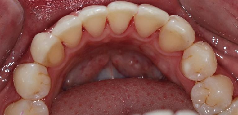 straight smile after dental treatment l dentist goffstown nh
