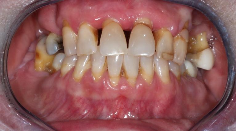 stained teeth before dentures l goffstown dental