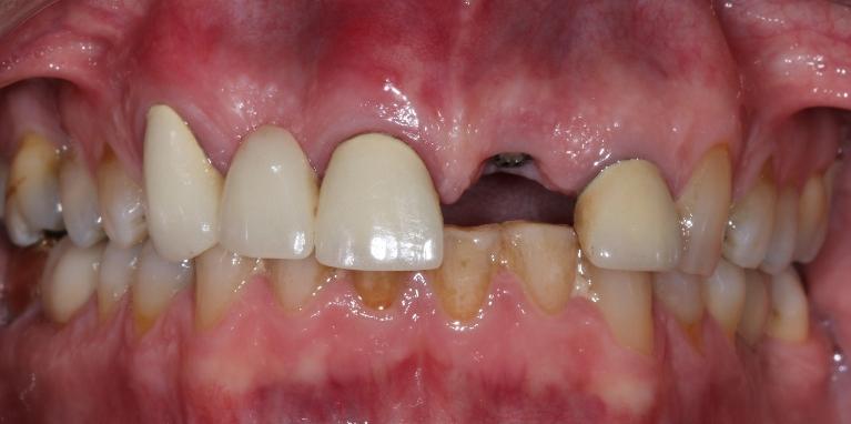 missing teeth before dental treatment l dentist goffstown nh