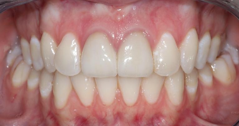 overbite before Invisalign l orthodontist in goffstown