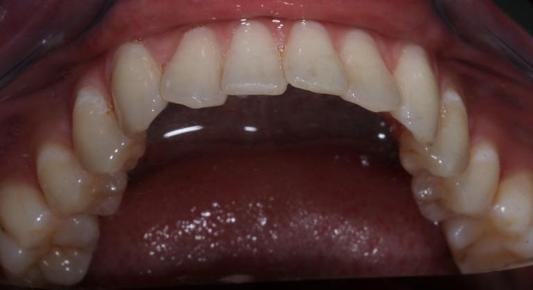 crooked teeth before Invisalign l orthodontics goffstown nh