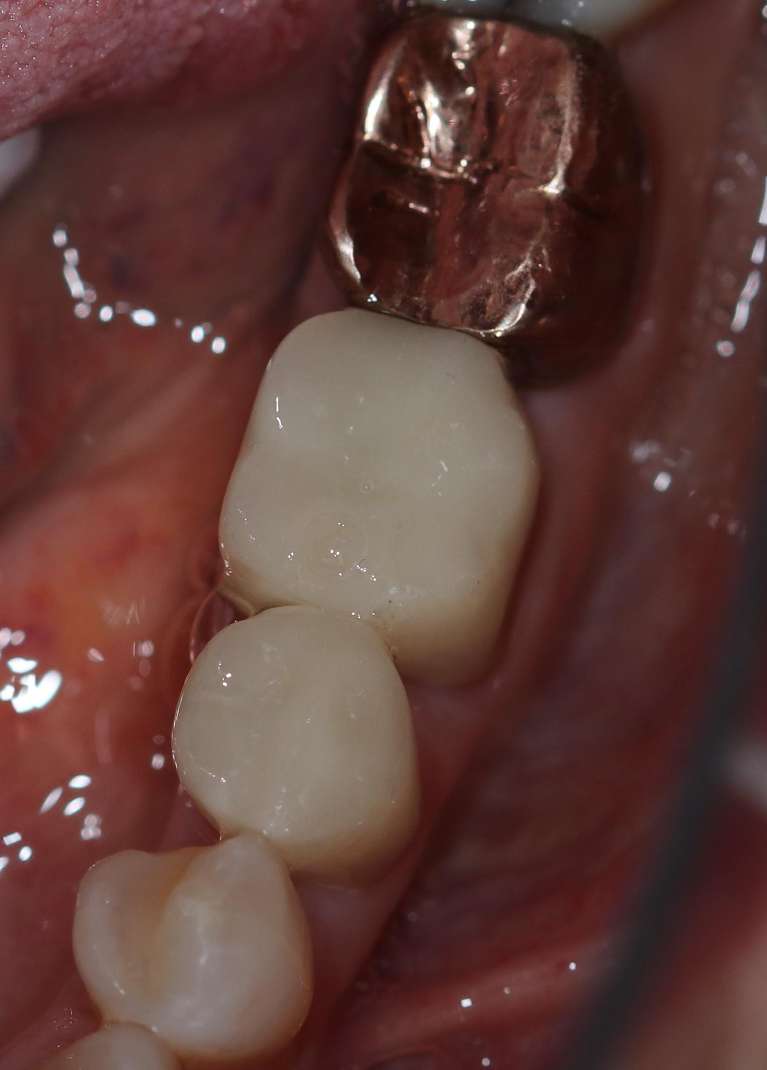 Dental-Crowns-After-Image