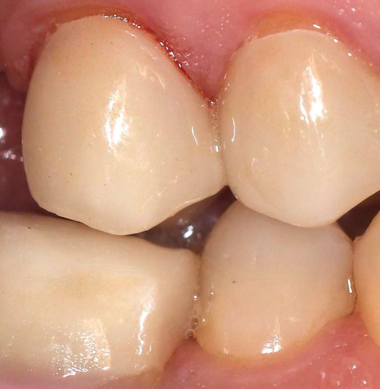 dental crowns in manchester- after