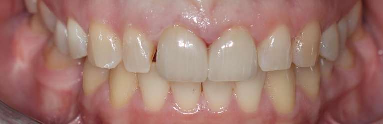 Dental-Crowns-After-Image