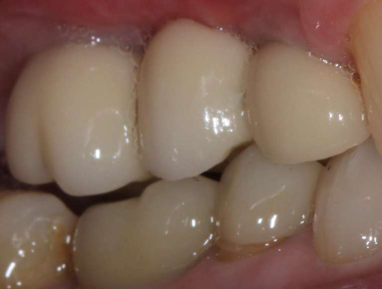 manchester implants- after photo