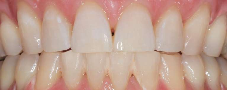 Teeth whitening in Manchester, NH- After
