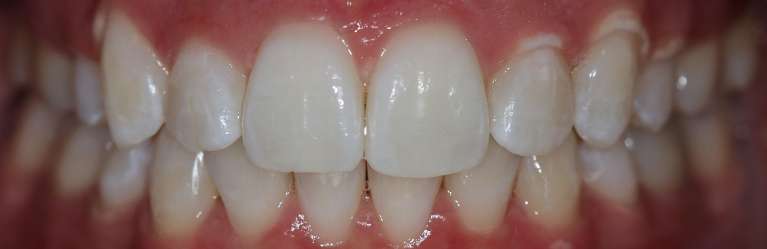 Invisalign-and-KOR-Whitening-Transformation-After-Image