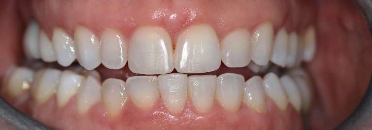 Invisalign-Case-After-Image