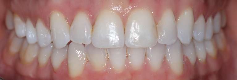 Invisalign-Transformation-After-Image