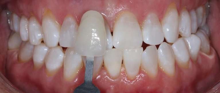 KOR-whitening-After-Image