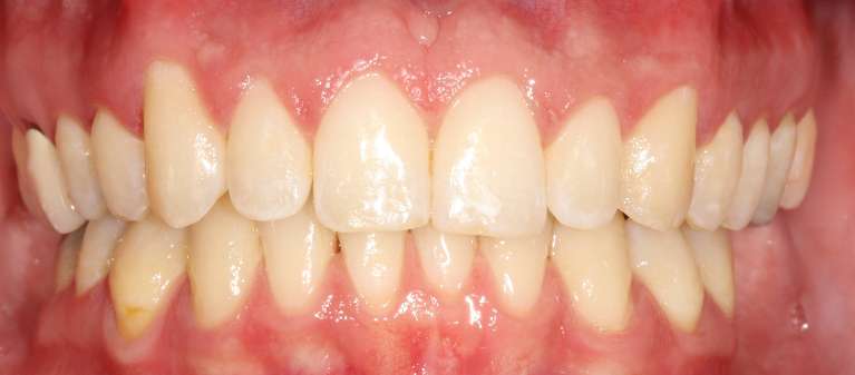 bright smile after dental treatment | invisalign goffstown nh