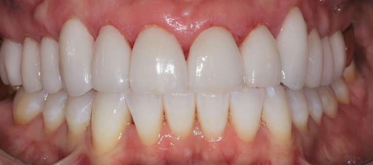 Smile makeover in Manchester, NH- After