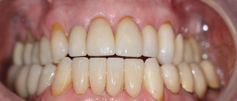 Smile-Makeover-After-Image