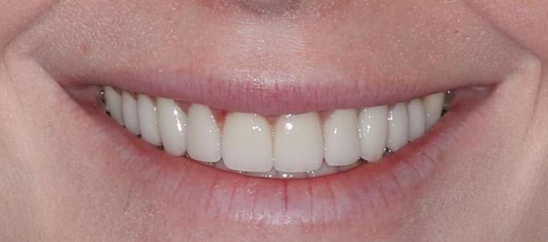 Smile-Makeover-After-Image