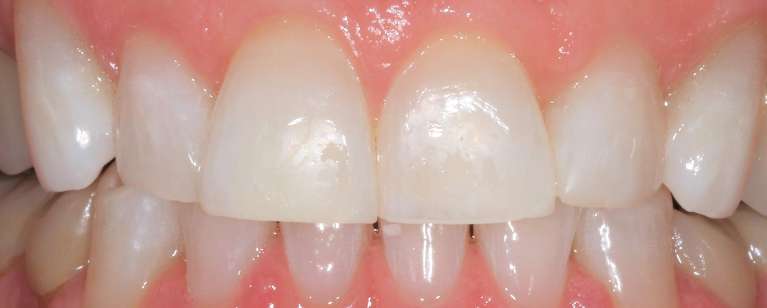 KOR whitening in Manchester, NH- After