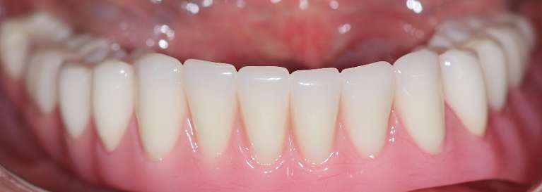 Implants in Manchester, After photo