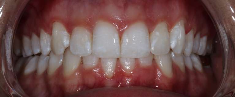 After KOR whitening | best beford dentist