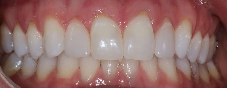 Gingival-Recontouring-After-Image