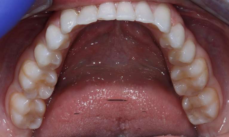 Invisalign Case in manchester NH- After Photo