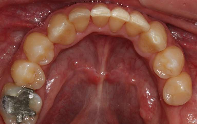straight smile after orthodontics | invisalign goffstown nh