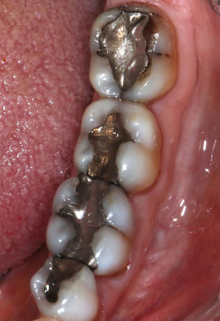 Dental-Crowns-Before-Image