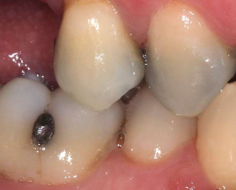 dental crowns in manchester- before