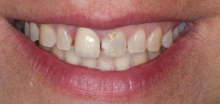 Dental-Crowns-Before-Image