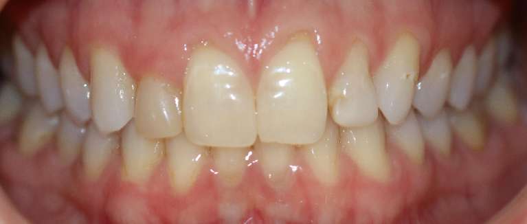 Gingival-Recontouring-Before-Image