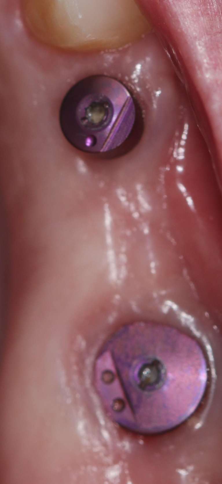 manchester implants- before photo