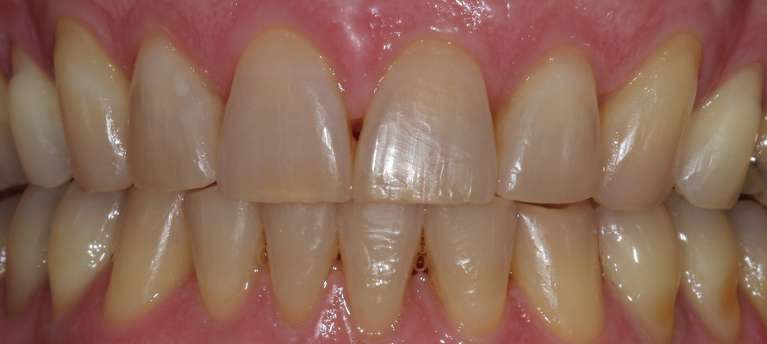 Teeth whitening in Manchester, NH- Before
