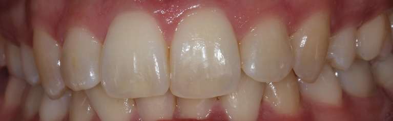 Invisalign-and-KOR-Whitening-Transformation-Before-Image