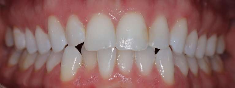 Invisalign-Transformation-Before-Image