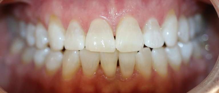 KOR-whitening-Before-Image