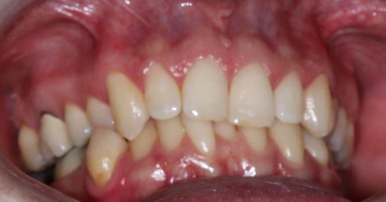 smile before orthodontics | goffstown nh dentist