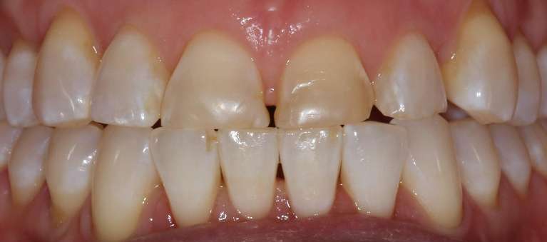 Smile makeover in Manchester, NH- Before