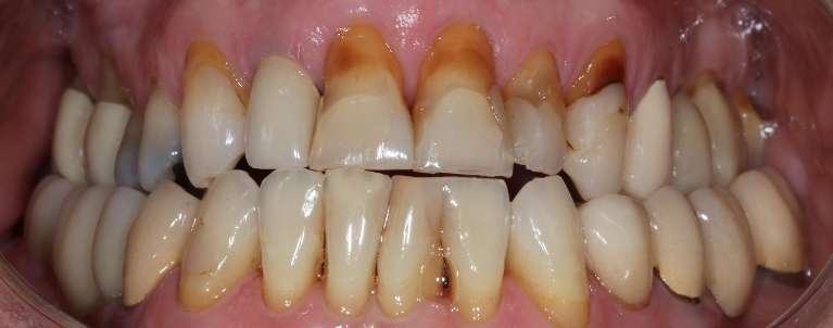 Smile-Makeover-Before-Image