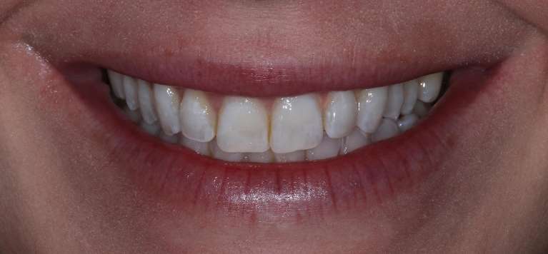 Smile-Makeover-Before-Image