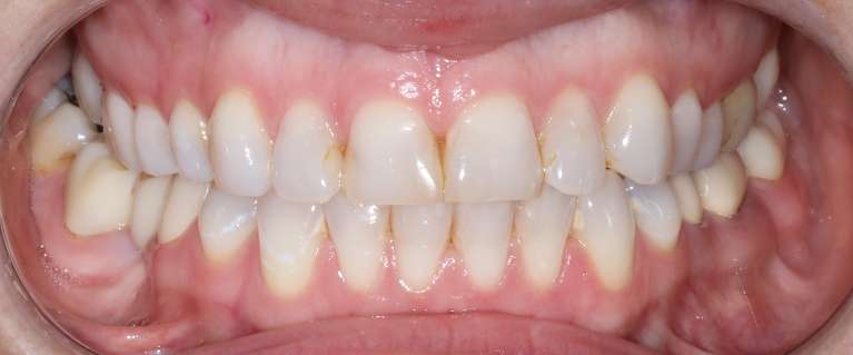 smile makeover in manchester NH- Before Photo