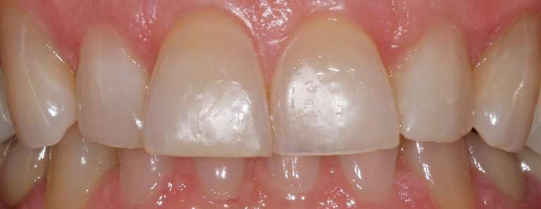 KOR whitening in Manchester, NH- Before