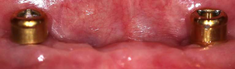 Implants in Manchester, Before Photo