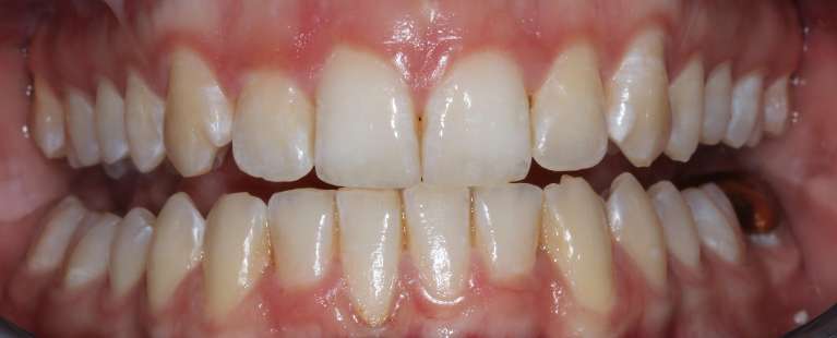 Before KOR teeth whitening | cosmetic dentist bedford