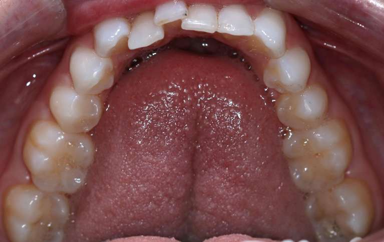 Invisalign Case in manchester NH- Before Photo
